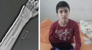 Kolu Kırıldı: Malzeme Kıtlığı Nedeniyle 13 Gündür Ameliyat Olamıyor