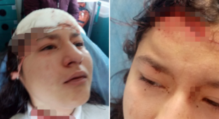 14 Yaşındaki Kız 5 Başıboş Köpeğin Saldırısına Uğradı