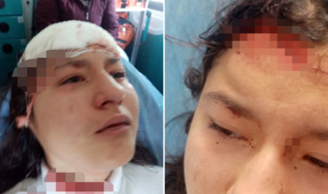 14 Yaşındaki Kız 5 Başıboş Köpeğin Saldırısına Uğradı