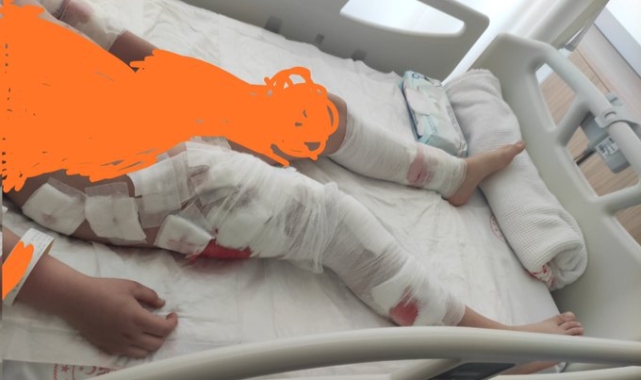 Başıboş 8 Sokak Köpeği Okula Giden 10 Yaşındaki Çocuğu Parçaladı