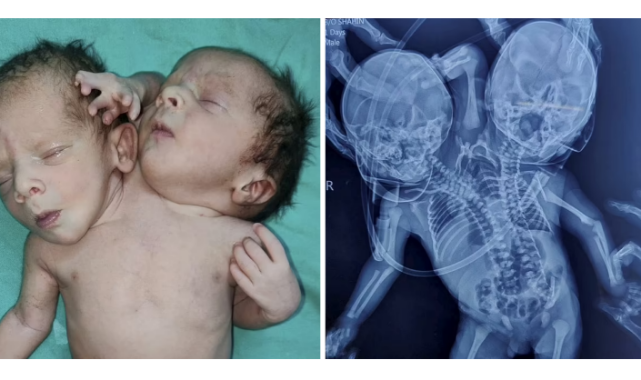 Hindistan'da İki Başlı, Üç Kollu ve İki Kalpli Bir Bebek Dünyaya Geldi