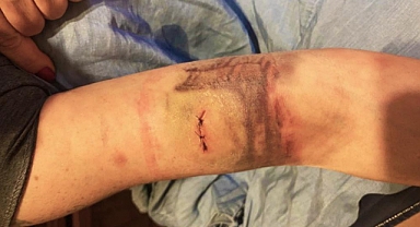 Çankaya'da Evinin Bahçesinde Gezen Kadına 6 Başıboş Köpek Saldırdı