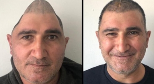 Kafatasının Yüzde 83'ü Parçalandı: 3 Boyutlu Yazıcılar Sayesinde Eski Görüntüsüne Döndü