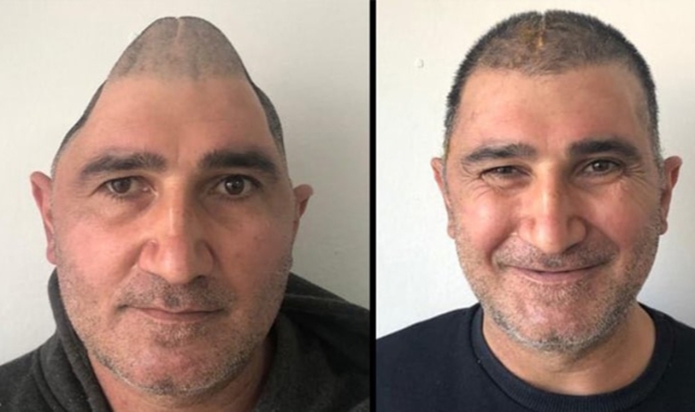 Kafatasının Yüzde 83'ü Parçalandı: 3 Boyutlu Yazıcılar Sayesinde Eski Görüntüsüne Döndü