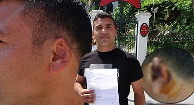 Kavgada Isırılarak Kopartılan Kulağı Martı Kaptı