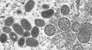 Maymun Çiçeği Giderek Yayılıyor: Virüsün Belirtileri, Bulaşma Yolları ve Risk Grubu