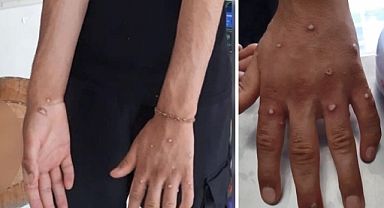 İstanbul'da Yabancı Uyruklu 3 Kişide Maymun Çiçeği Şüphesi