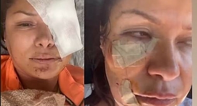 Köpek Saldırısına Uğrayan Tuğba Altıntop: Hata Bende