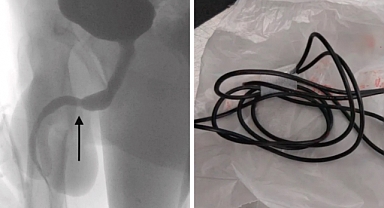 Penisine USB Kablo Sokan Genç Ameliyata Alındı