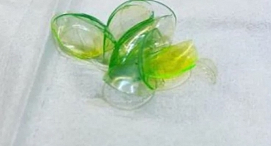 Uyumadan Önce Çıkarmayı Unuttu: Gözünden 23 Kontakt Lens Çıkarıldı