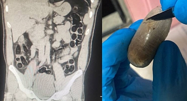 Batman'da Yakalanan İranlının Midesinden 714 Gram Eroin Çıktı