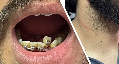 Sakarya Eğitim Araştırma Hastanesi'nde Genç Doktora Saldırı: Dişini Kırdılar