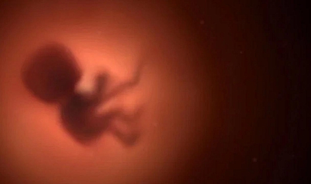 84 Yaşındaki Kadının Karnında 40 Yıllık Cenin Bulundu
