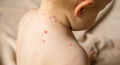 Sağlık Bakanlığı'ndan Kızamık Alarmı: 81 İle Yazı Gönderildi