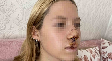 Sultangazi'de Yüzüne Kaldırım Taşı Atılan Genç Kız Konuştu