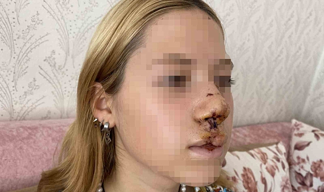 Sultangazi'de Yüzüne Kaldırım Taşı Atılan Genç Kız Konuştu