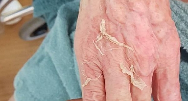 Huzurevinde Banyo Yaptırıldıktan Sonra Ölen Yaşlı Kadın İçin Rapor Çıktı: Dermatolojik Hastalık Tespit Edilmedi