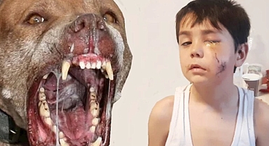 Bandırma Belediye Başkanı'nın Pitbullu Bir Çocuğun Yüzünü Parçaladı