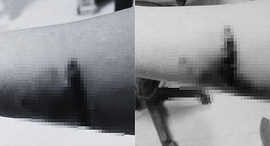 Diyarbakır'da 14 Yaşındaki Kız Çocuğu Başıboş Köpeklerin Saldırısına Uğradı