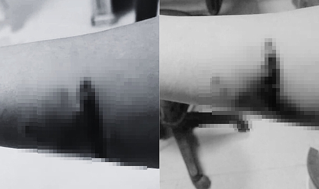 Diyarbakır'da 14 Yaşındaki Kız Çocuğu Başıboş Köpeklerin Saldırısına Uğradı
