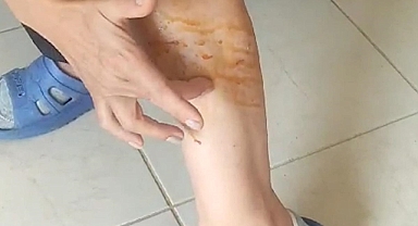 Başıboş Sokak Köpekler Sabah Sporu Yapan Kadına Saldırdı: 'Küçük veya Yaşlı Bir İnsan Olsaydı Kötü Sonuçlar Olabilirdi.'