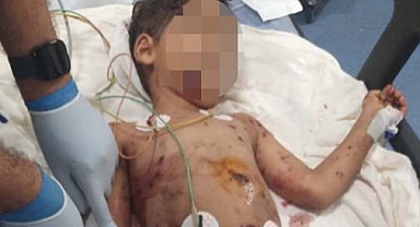 Adana'da Başıboş Köpeklerin Saldırısına Uğrayan 5 Yaşındaki Çocuk Ağır Yaralandı