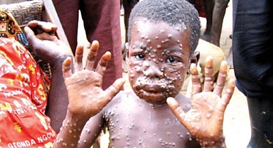 DSÖ'den Yeni Maymun Çiçeği Virüsü Uyarısı: Afrika'da Acil Durum İlan Edildi