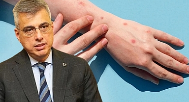 Sağlık Bakanı Memişoğlu'ndan 'Maymun Çiçeği Virüsü' Açıklaması: Ülkemizde İnşallah Olmasın