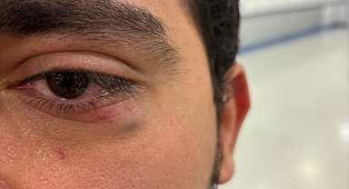 ODTÜ'de Biti Kanlanan Kürtçülerin Saldırıları Devam Ediyor: Bir Türk Milliyetçisi Öğrenciyi Daha Pusuya Düşürerek Darp Ettiler