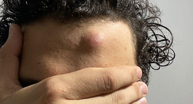 ODTÜ'de Başına Darbeli Biber Gazı Kapsülü İsabet Eden Öğrenci TamgaTürk'e Konuştu