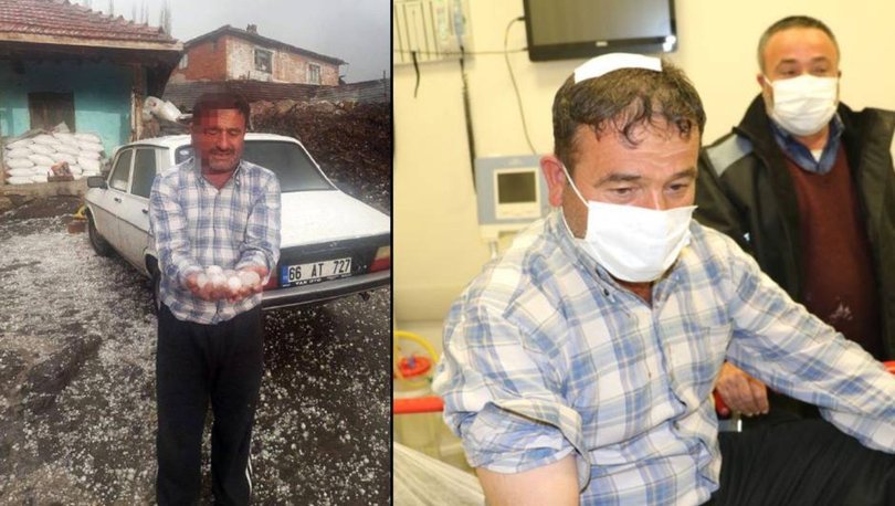 Yumurta Büyüklüğündeki Dolu Yüzünden Hastanelik Oldu