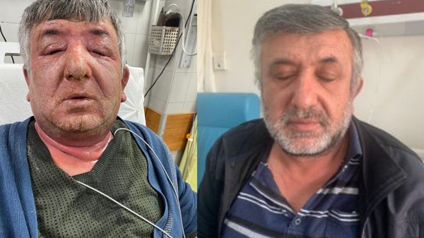 Kullandığı Dezenfektan Hastanelik Etti