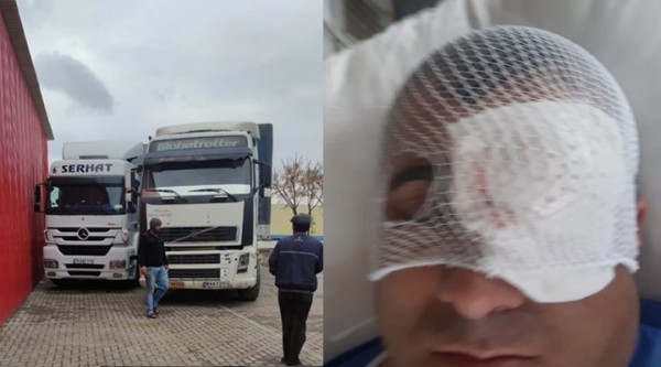 İranlı Şoförlerin Saldırısına Uğrayan Tır Şoförü Sol Gözünü Kaybetti