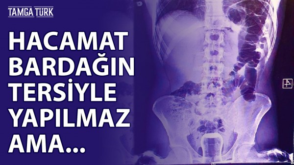 Böyle Hacamat Kazası Görülmedi