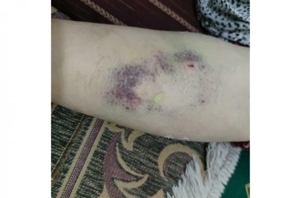 Mardin'de Yaşlı Bir Kadın Başıboş Köpek Tarafından Isırıldı