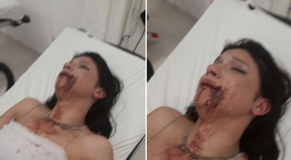 Transfobik Saldırı: Beren Ecmel’in Yüzünü Kestiler 