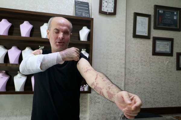 İzmir'de Bir Kuyumcu Kezzaplı Saldırıda Bir Gözünü Yitirdi