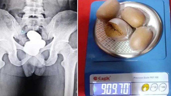 Kaçakçının Makatından 1 Kiloya Yakın Altın Çıktı